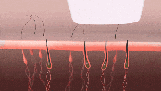 兩種脫毛儀-808orOPT，你會(huì)如何選