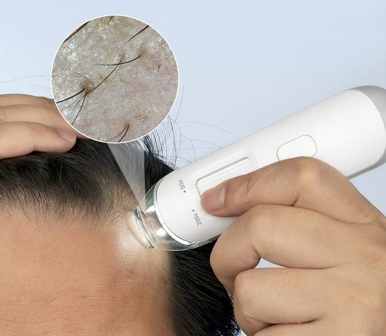 頭皮檢測(cè)儀原理 頭皮檢測(cè)儀原理